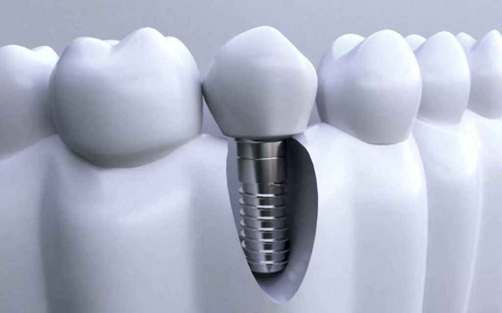 Dental screws 2