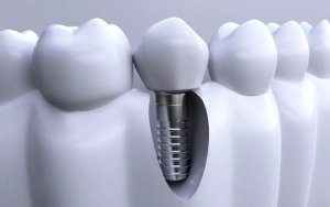 Dental screws 2